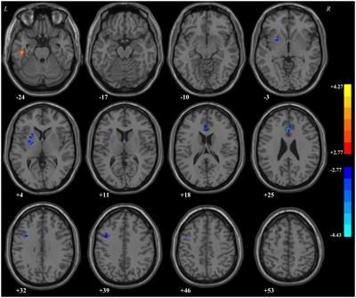 Multiple examinations indicated associations between abnormal regional homogeneity and cognitive dysfunction in major depressive disorder